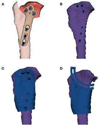 Efficacy of a Customized Three-Dimensional Printing Surgical Guide for Tibial Plateau Leveling Osteotomy: A Comparison With Conventional Tibial Plateau Leveling Osteotomy